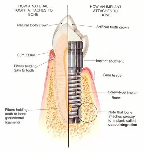 dental implant healing stages