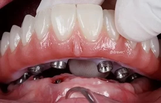 dental-implant-healing-stages