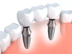 dental implant healing stages