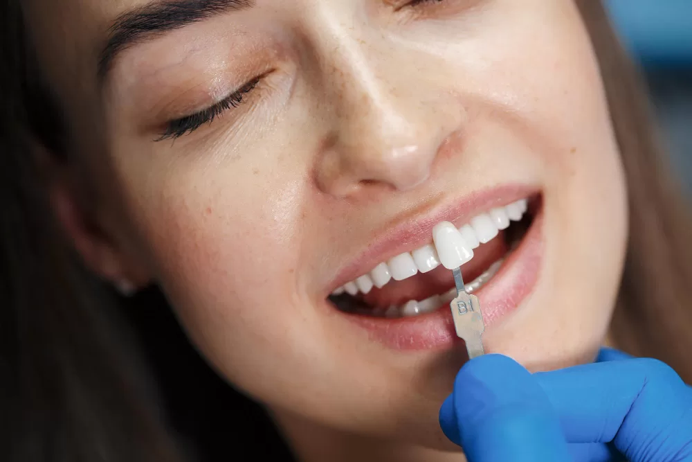 veneers process