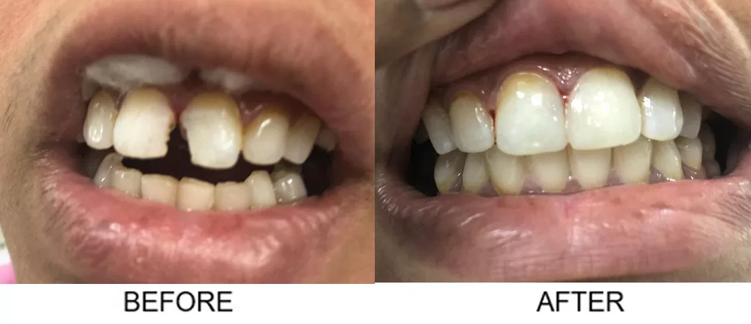 tooth filling