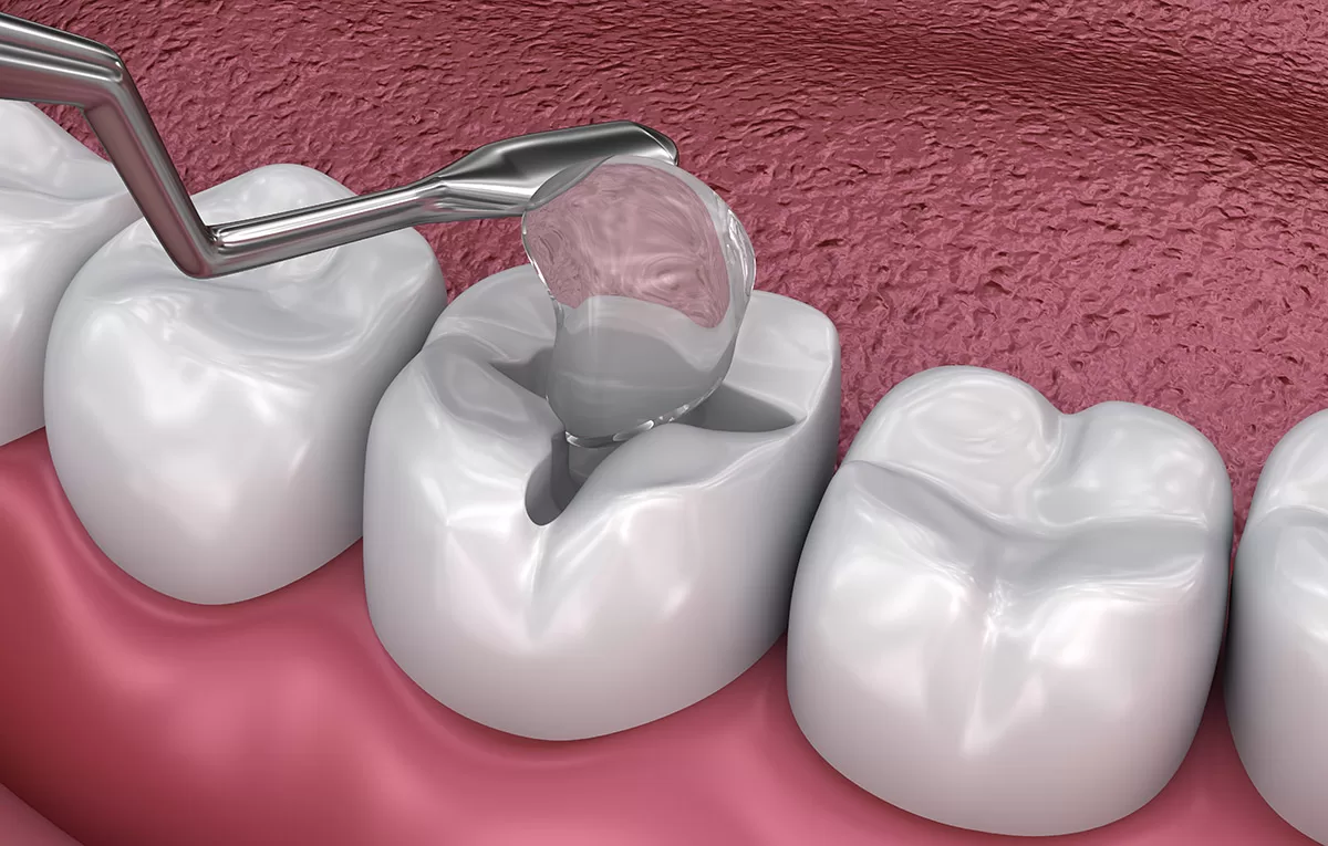 tooth filling
