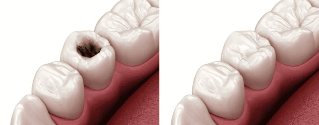 Tooth Filling: What is it and what we need one?