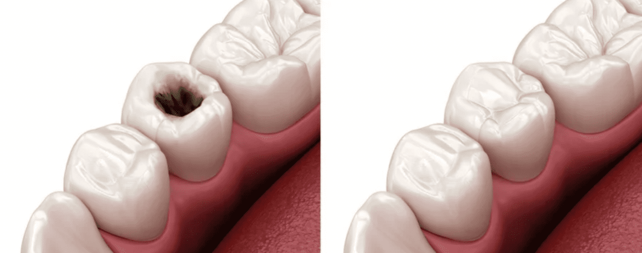 tooth filling