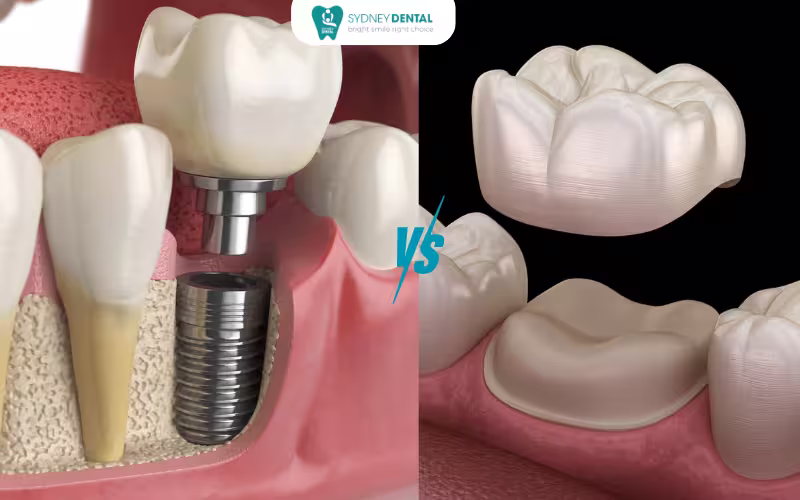 Crowns and implants dentistry: What's the Best Choice for You?