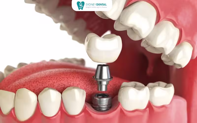A dental crown and an implant structure, showing the difference in design and components