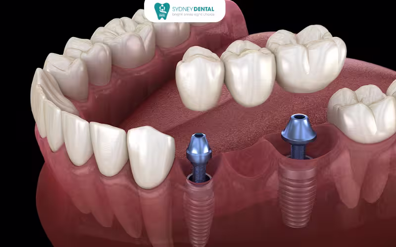Dentist explaining post-treatment care instructions after dental crown and implant procedures