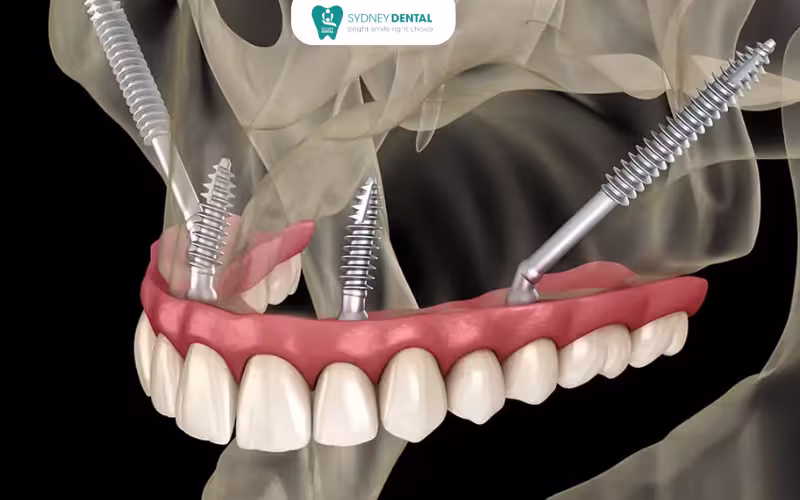 Zygomatic implants vietnam replace missing teeth by securely attaching long titanium posts into the zygomatic bone