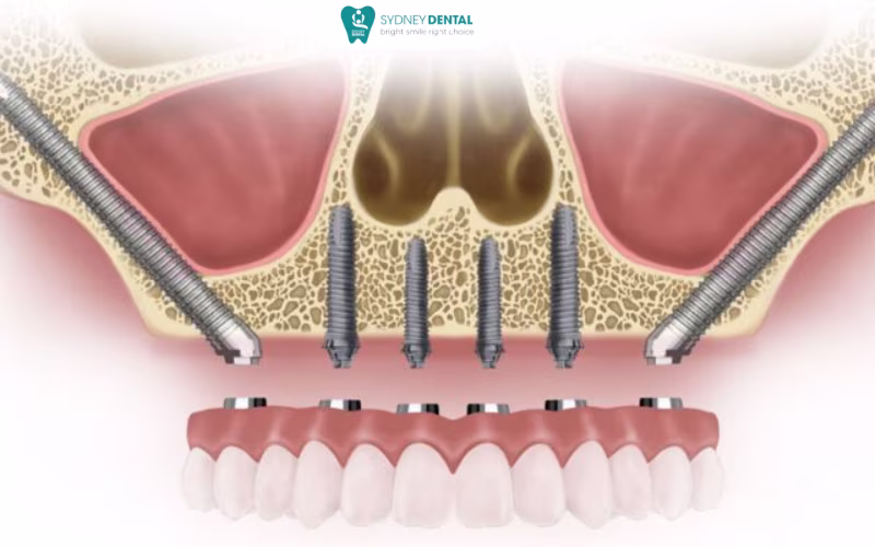 Zygoma Implant allows full-arch and partial tooth restoration even in patients with severe bone loss