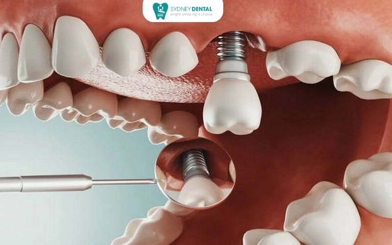 Osseointegration – the critical stage when your bone naturally fuses with the implant, ensuring long-term stability