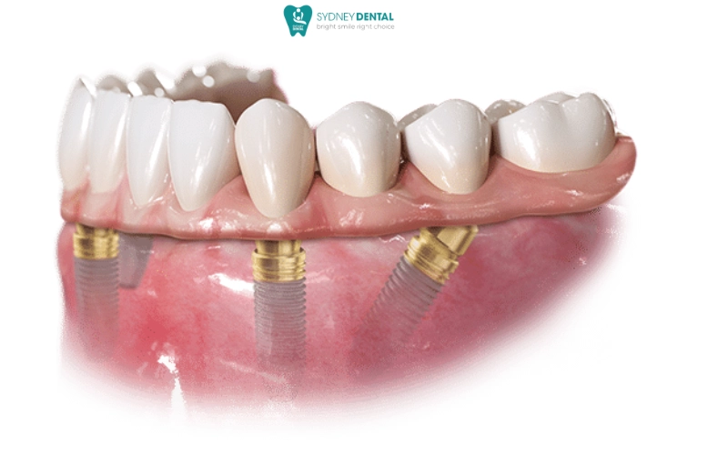 Multiple factors such as age, smoking habits, bone quality, and oral hygiene can affect your healing timeline