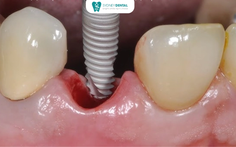 The final crown is placed – a confident smile restored for years to come