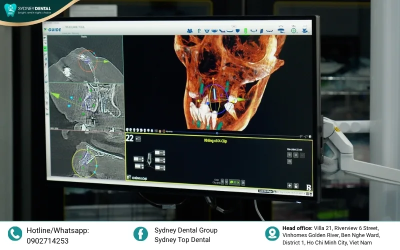 Precision guided by X-Guide Dynamic Navigation – The "GPS" for safe and accurate implant placement.