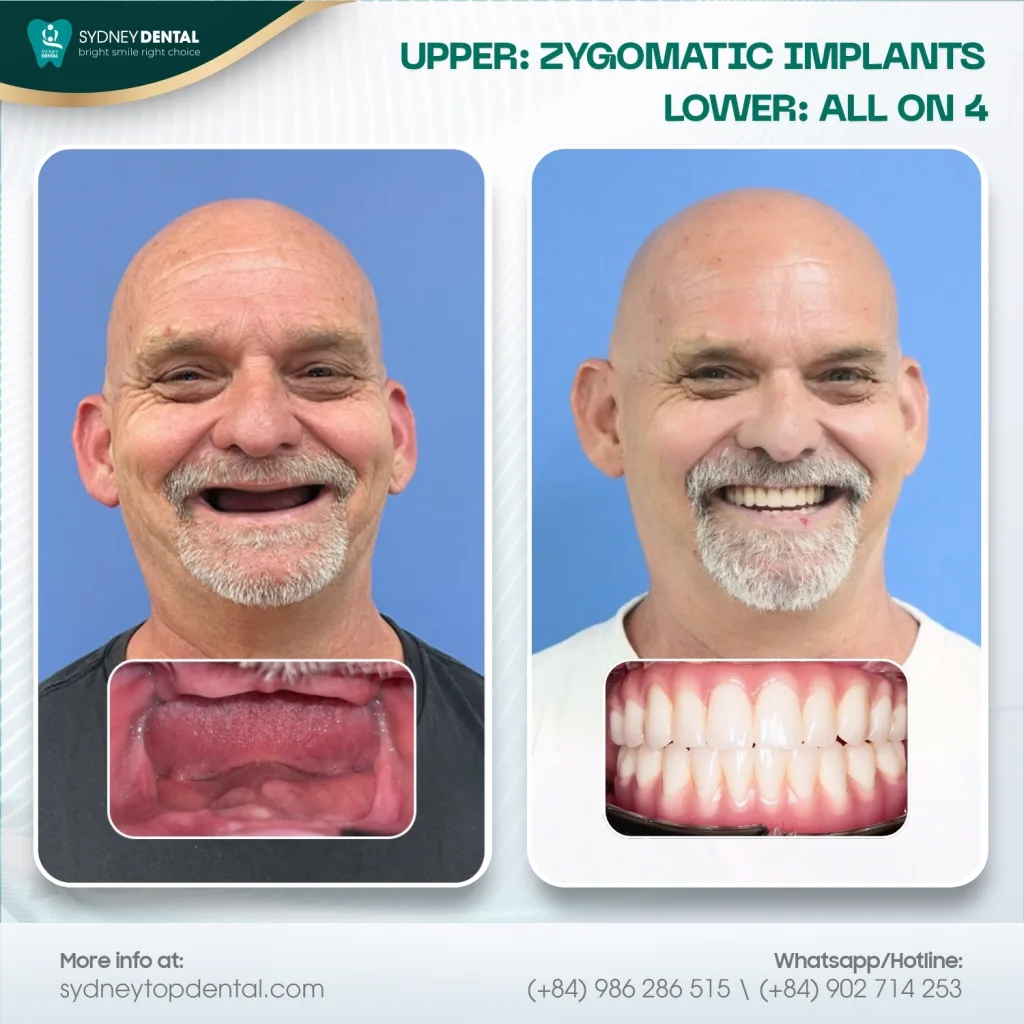 A zygomatic implant is significantly longer than a standard implant to reach the sturdy cheekbone