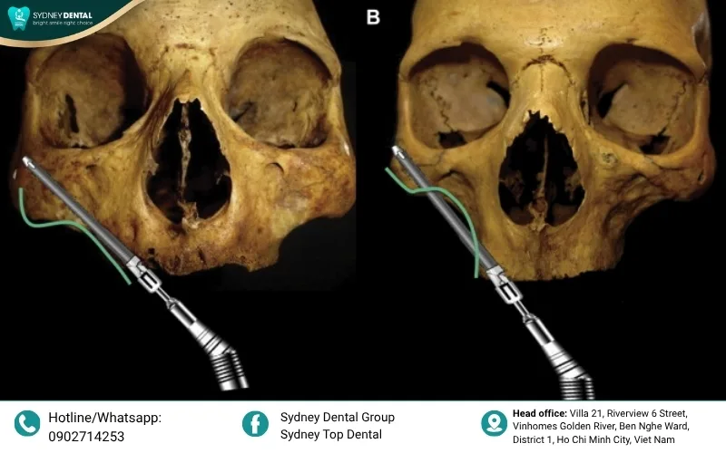 Advanced placement protocols: The Quad Zygoma and Hybrid solutions are customized based on the patient’s remaining bone volume.