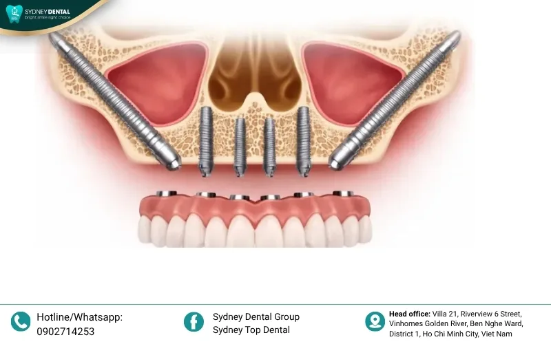 While standard implants are placed in the jawbone, Zygomatic Implants anchor securely into the high-density bone of the cheek.