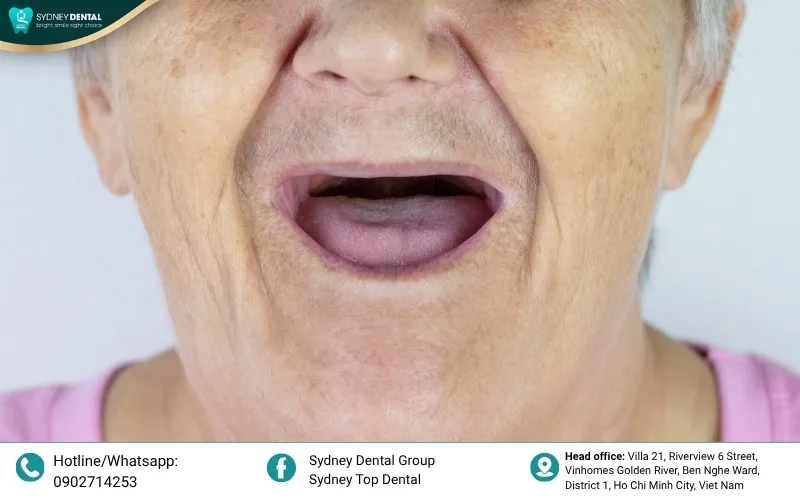 The "saving grace" for severe bone loss: Zygoma implants are the only predictable solution for Grade IV, V, and VI bone resorption where traditional methods are no longer viable