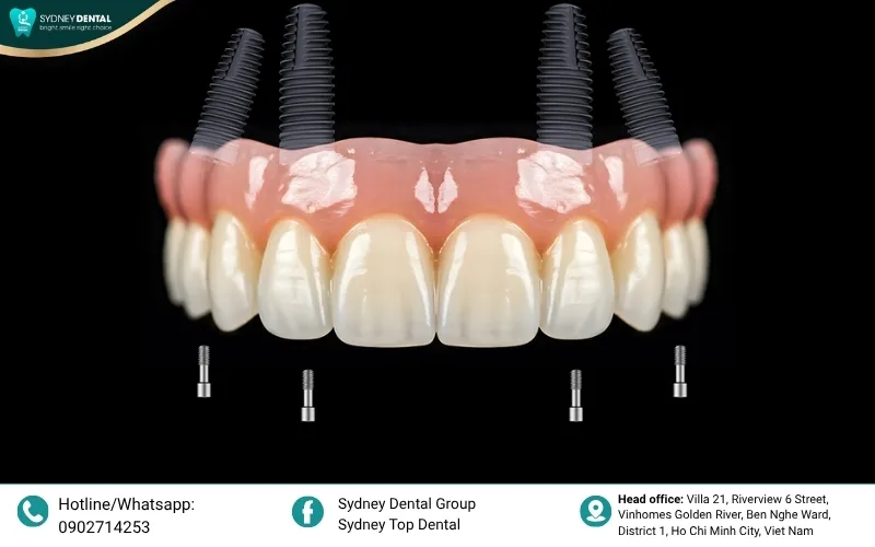 The All-on-4 mechanism: Two tilted posterior implants provide maximum stability without the need for bone grafting.