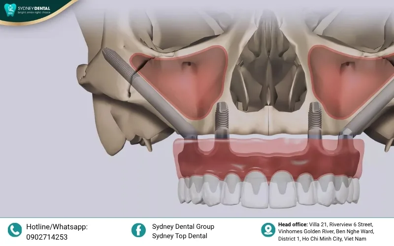The specialized length and complex design of Zygoma implants require advanced manufacturing, contributing to their higher value compared to standard screws