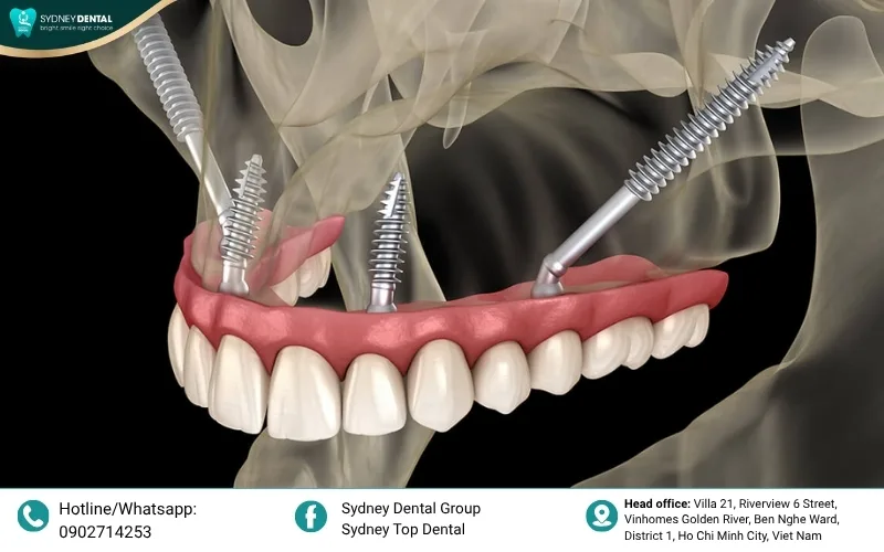 We exclusively use world-renowned implant systems like JD Zygoma and Straumann, backed by lifelong global warranties and clinical research