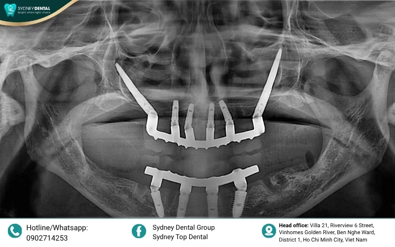 Zygomatic implants provide a stable foundation by anchoring into the cheekbone, bypassing areas of severe bone loss.