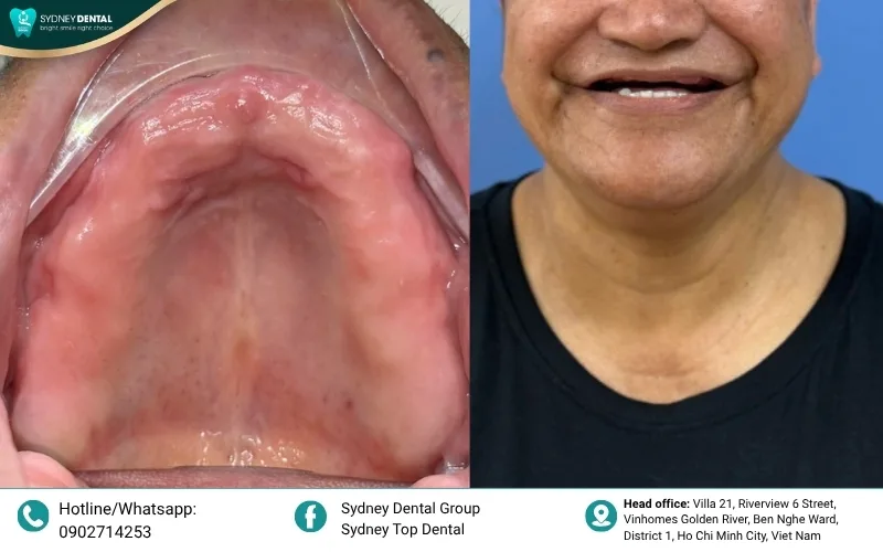 Ideal for patients with severe bone loss or failed previous implant procedures who were told they have "no bone left."