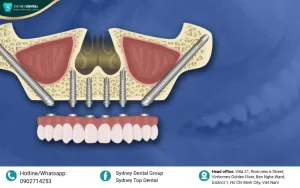 Dental implants in cheekbone: The Ultimate Solution for Severe Bone Loss