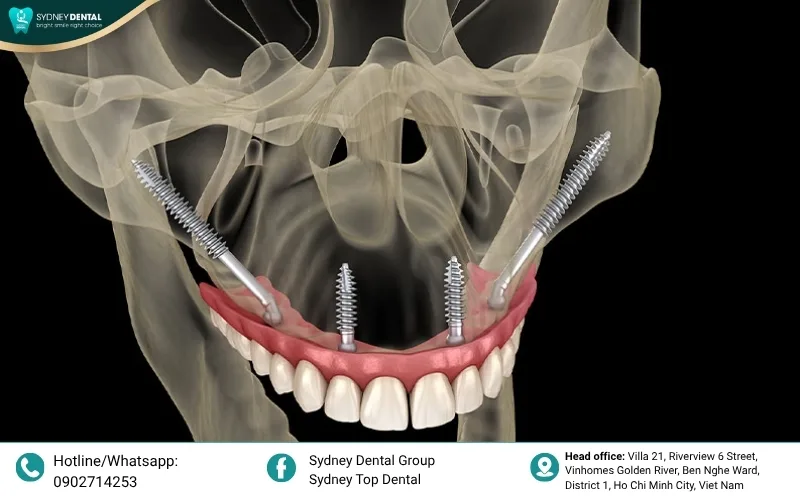 While highly successful, zygomatic surgery requires extreme expertise and a sterile hospital-standard environment.