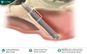 Zygomatic Implant in Ho Chi Minh City: The Optimal Solution for Severe Bone Loss