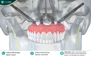 Zygomatic Dental Implants in Vietnam: The Gold Solution for Severe Bone Loss
