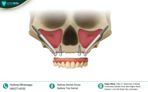 Zygomatic Bone Anatomy: Structure, Function, and Clinical Applications