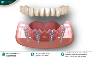 Medical Standard Dental Implant Procedure: What You Need to Know