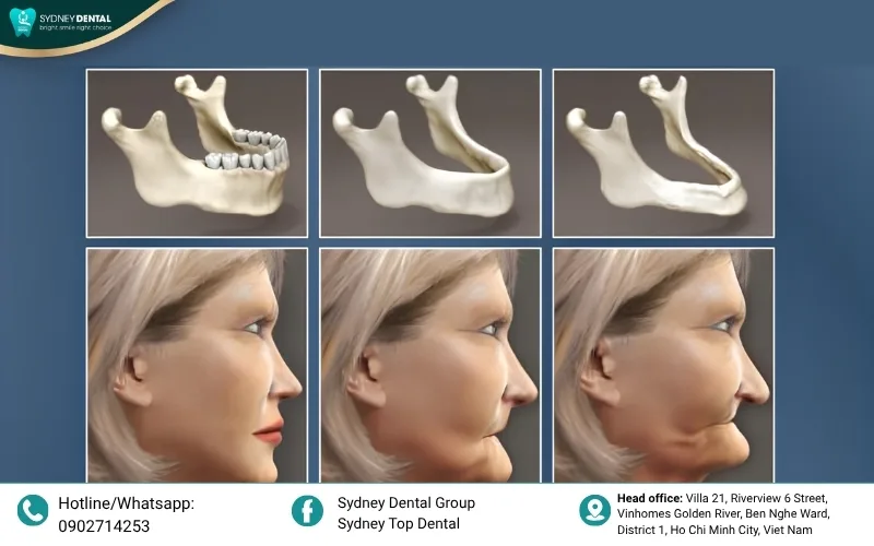 Even patients with moderate bone loss can be candidates for All-on-4 thanks to the angled placement of posterior implants
