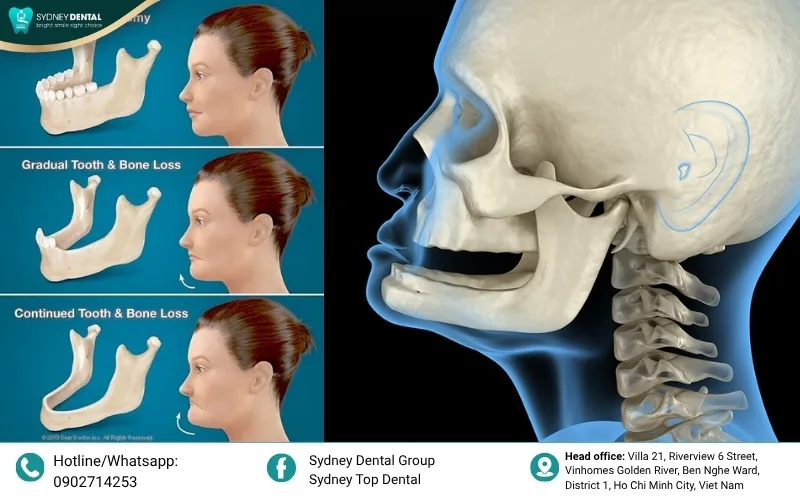 Chewing pressure provides the vital stimulation needed to maintain healthy jawbone density.