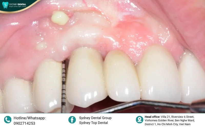 The final porcelain bridge restoration provides a natural and fully functional smile.