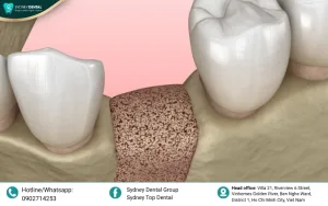 Can Bone Loss Be Treated with Dental Implants? Optimal Solutions