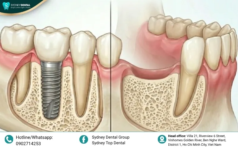 Various bone grafting materials used to rebuild a stable foundation for dental implants.