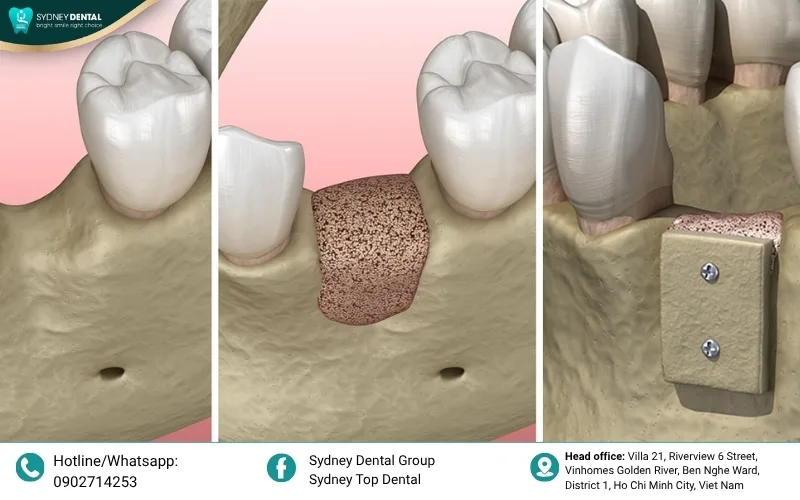 Ridge expansion technique used to restore the width of a narrow alveolar bone.