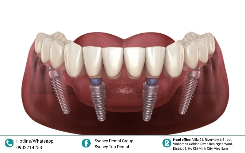 All-on-4 and All-on-6 systems: Efficient solutions for full-arch restoration with moderate bone loss.