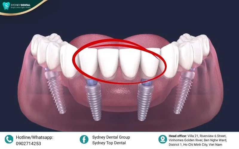 The average cost of a dental bridge in 2026 varies based on complexity and location