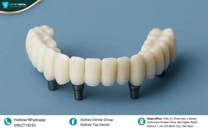 Understanding the structural differences between a dental bridge and a dental implant.