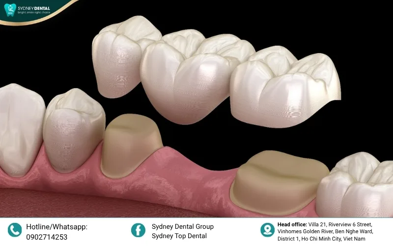 A traditional dental bridge uses two healthy adjacent teeth as anchors for the restoration