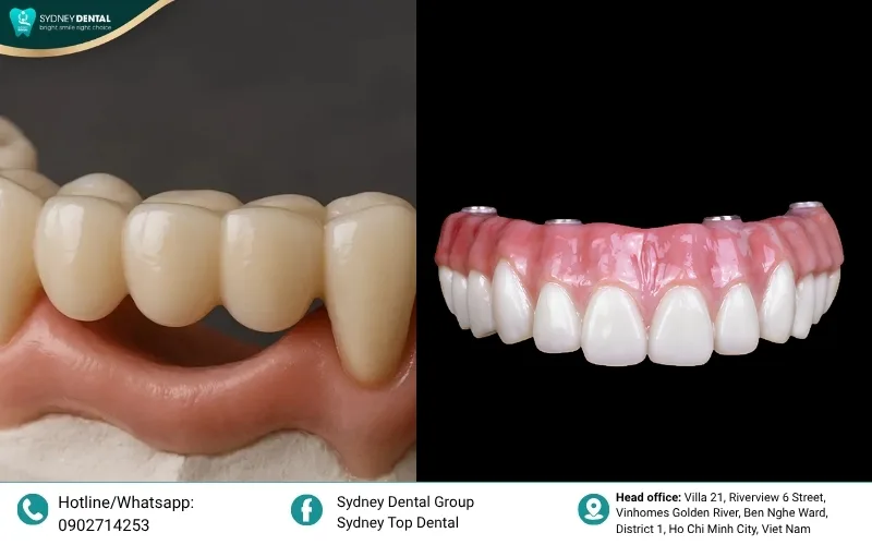 Visual comparison between budget-friendly metal-based bridges and high-end all-ceramic Zirconia.