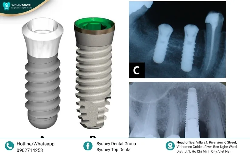 Successful dental implants abroad require careful timing to allow for proper healing and bone integration between visits.