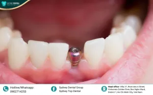 Top 5 Countries for the Most Affordable & Reliable Dental Implants 2026
