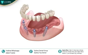 Top 5 Countries Cheapest Dental Implants In The World