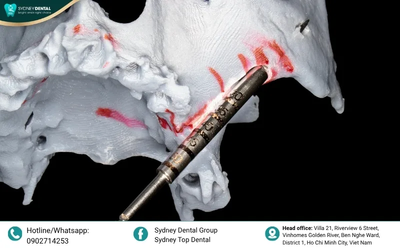 Always ensure your clinic uses globally recognized, genuine materials with a verifiable warranty.