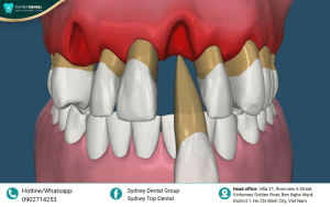 Gum Recession & Bone Decay: Signs and Effective Treatment Solutions