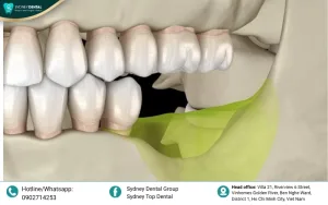 Jaw Bone Loss: Causes, Consequences, and Solutions from Experts