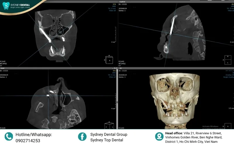 Dr. Nguyen Ngoc Hai’s precision: The post-op X-ray shows the successful integration of Zygomatic and All-on-6 implants